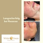 Rosazea Problemhaut Rosacea Behandlung