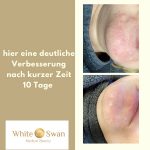 couperose Problemhaut Behandlung Verbesserung